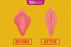 Thu nhỏ môi bé giá bao nhiêu? Bảng giá chi tiết mới nhất