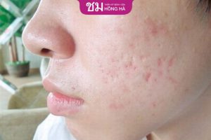 Trị thâm sẹo rỗ lâu năm có khó không? 4 Yếu tố ảnh hưởng