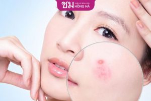 Vị trí mọc mụn nói lên điều gì? Cách trị mụn an toàn, hiệu quả