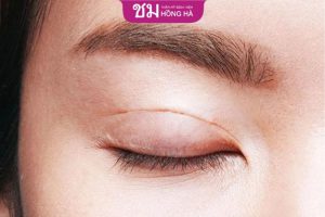 Xóa sẹo cắt mí và cách phòng ngừa sẹo xấu hiệu quả