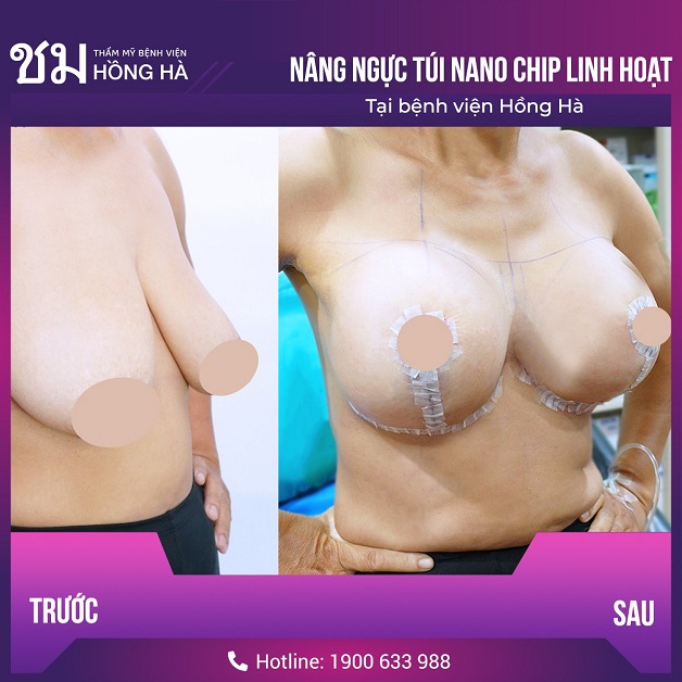 Treo ngực sa trễ bằng túi nano chip linh hoạt