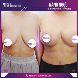 Treo ngực sa trễ: Hồi sinh vòng 1 nhanh chóng sau 60 phút