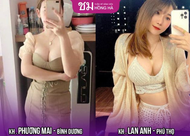 Khách hàng sở hữu dáng ngực quyến rũ sau khi Dr.Robert Nguyễn trực tiếp phẫu thuật