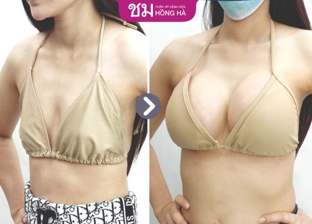Feedback nóng bỏng tay của chị khách hàng sau khi nâng ngực công nghệ Thái