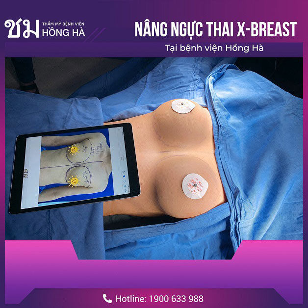 Nâng ngực Thai X - Breast là phương pháp cải thiện vòng 1 chảy xệ