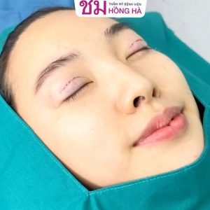 Cắt mí mắt sau bao lâu thì lành, đẹp đón tết