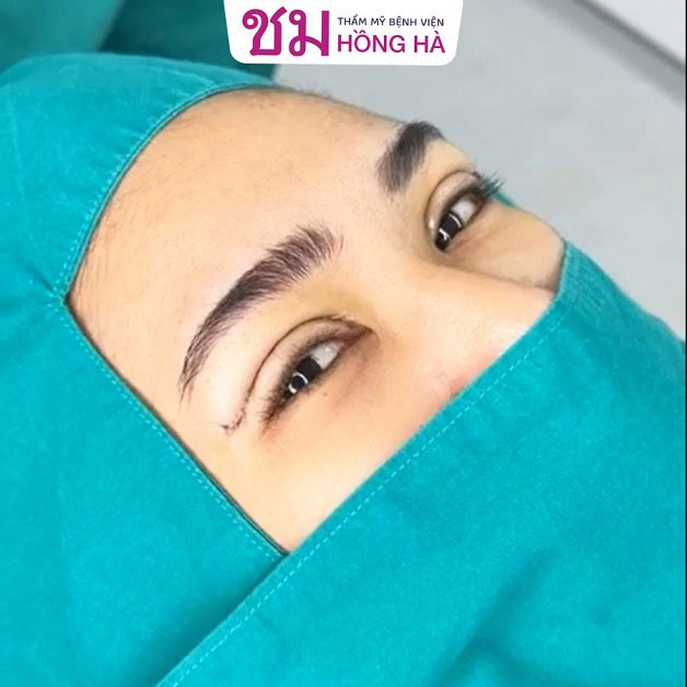 Cắt mí mắt sau bao lâu thì lành đẹp đón tết - giai đoạn từ 7 ngày trở đi