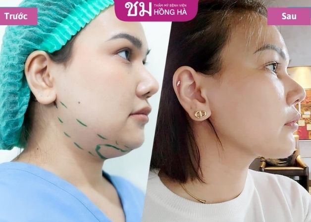 Tạm biệt vùng mỡ cằm nhanh chóng sau hút mỡ