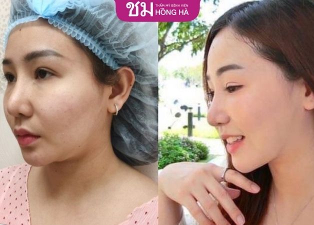 Kết quả hút mỡ cằm của chị Ngân