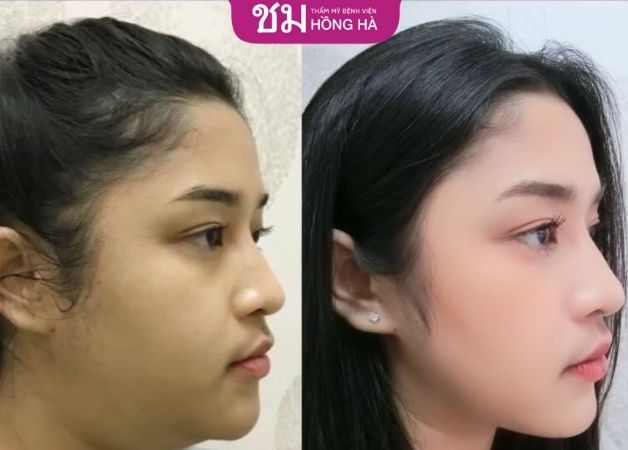 Kết quả khi hút mỡ cằm của chị Ánh