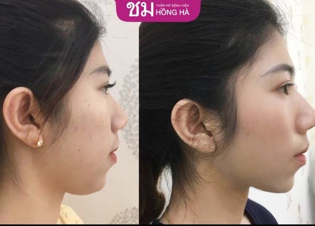 Hình ảnh trước - sau khi hút mỡ nọng cằm