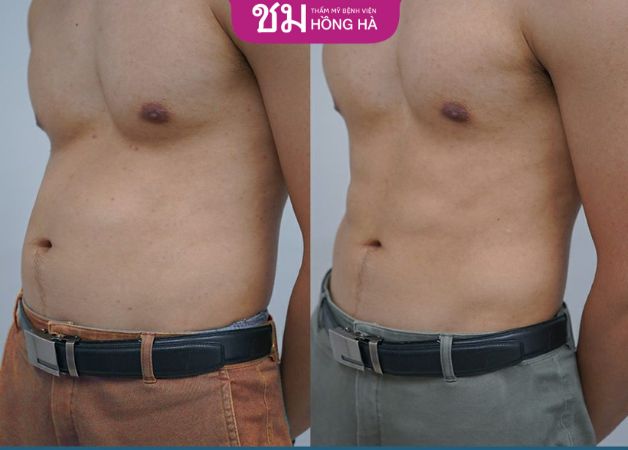 Khách hàng sử dụng dịch vụ giảm mỡ và tạo hình thành bụng