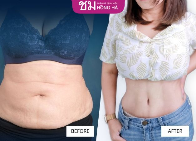 Hình ảnh trước sau khi tạo hình thành bụng thành công