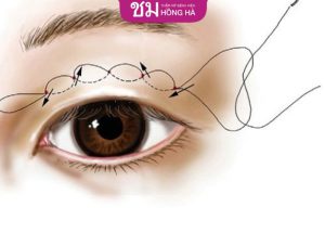 Có nên bấm mí mắt không – Dr.Daniel Nguyễn giải đáp