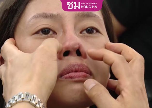 Khắc phục biến chứng bao xơ sau nâng mũi