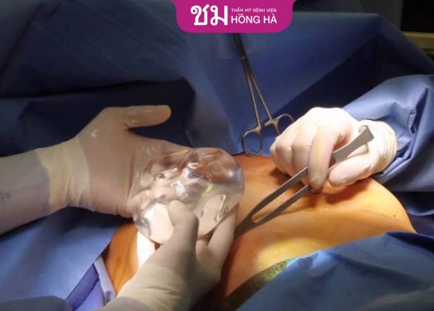 Phẫu thuật tạo khoang để thay thế túi độn mới