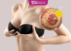 Dấu hiệu bị bao xơ sau nâng ngực – Nhận  biết qua 4 cấp độ