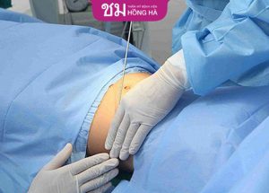 Địa chỉ hút mỡ bụng uy tín – Thẩm mỹ Bệnh viện Hồng Hà
