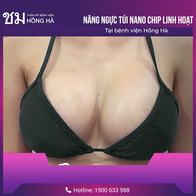 Nâng ngực không gây nguy hiểm nếu được thực hiện ở những đơn vị uy tín