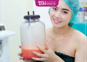 Lưu ý quan trọng hút mỡ sát tết nhanh hồi phục