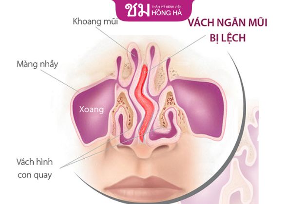 Người bị lệch sụn vách ngăn mũi đủ điều kiện thẩm mỹ nâng mũi