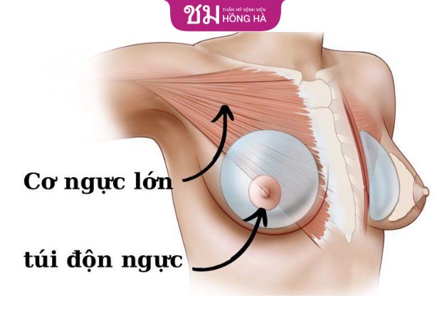 Vị trí đặt túi độn phù hợp