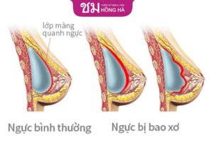 Nâng ngực bị bao xơ – Dấu hiệu và cách trị mà bạn nên biết