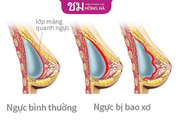 Nguyên gây ra co thắt bao xơ