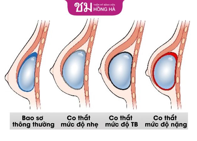 Dấu hiệu nhận biết nâng ngực bị bao xơ tùy vào từng giai đoạn