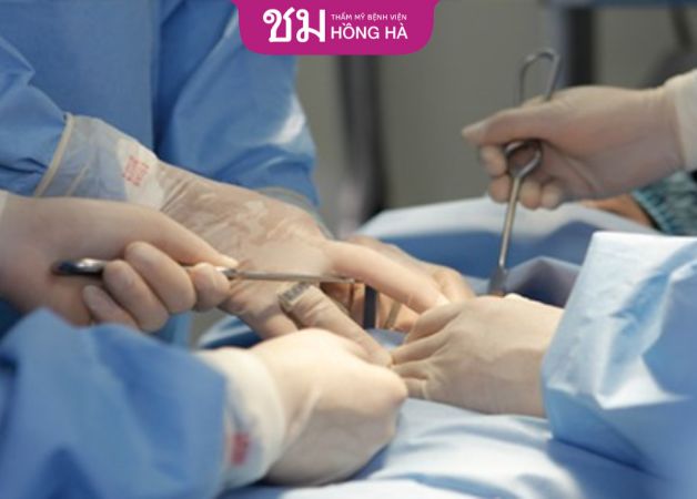 Khắc phục co thắt bao xơ sau nâng ngực