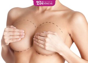 Nâng ngực có giảm tuổi thọ không – Chuyên gia trả lời