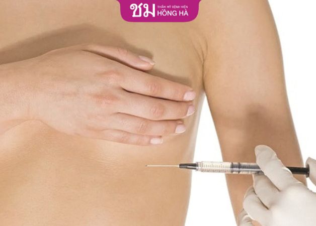 Nâng ngực bằng phương pháp làm đầy
