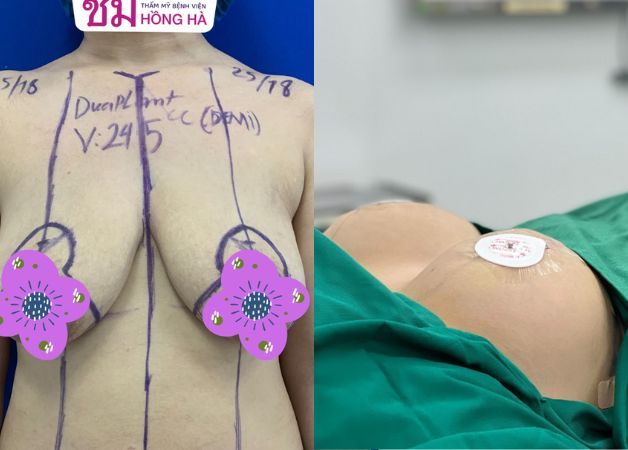 Hình ảnh trước và sau ngay khi vừa kết thúc phẫu thuật