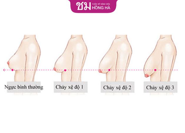 Phẫu thuật treo ngực sa trễ dựa theo từng cấp độ