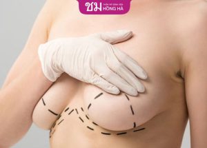 Nâng ngực sa trễ có để lại sẹo không? Cách ngăn ngừa sẹo hiệu quả