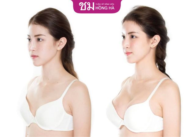 Khách hàng sở hữu vòng 1 quyến rũ sau nâng ngực công nghệ Thái Lan