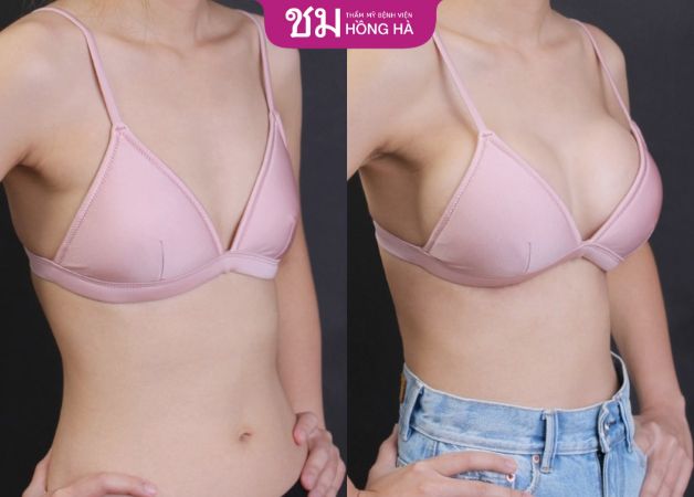 Khách hàng lột xác ngoạn mục sau khi nâng ngực