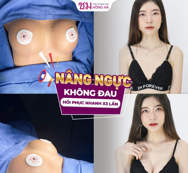 Thẩm mỹ nâng ngực ổn định nhanh chóng