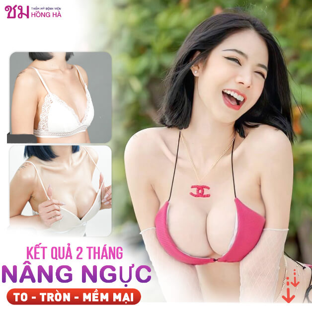Sau nâng ngực khoảng 1 - 2 tháng thì mềm đẹp tự nhiên