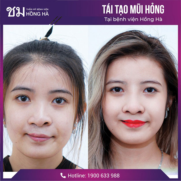 Chỉnh sửa thành công mũi hỏng do phẫu thuật thẩm mỹ tại thẩm mỹ viện Thái Lan tại Việt Nam