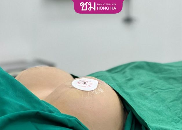 Phẫu thuật giúp khắc phục ngực chảy xệ, tạo sự săn chắc