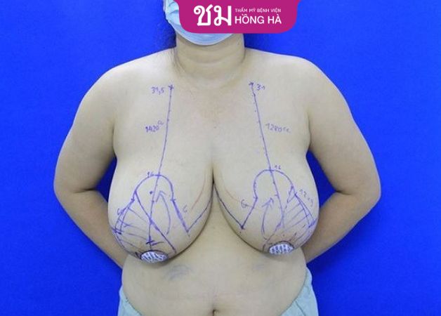 Phẫu thuật thu gọn ngực, giảm kích thước núi đôi quá khổ