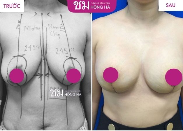 Khách hàng sở hữu khuôn ngực căng tròn sau treo ngực sa trễ