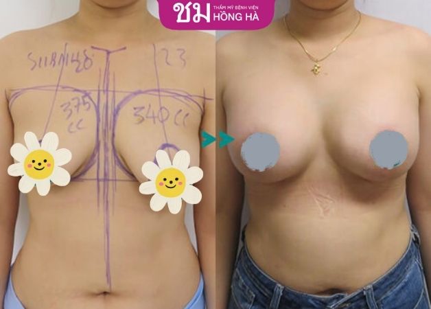 Hình ảnh trước sau của khách hàng sau khi treo ngực sa trễ