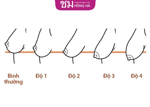 Các cấp độ sa trễ