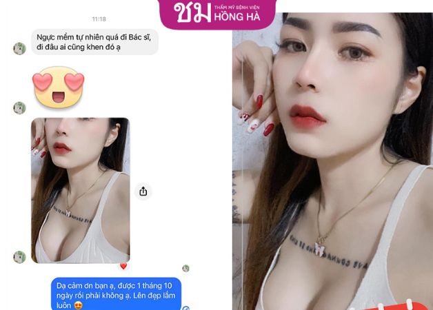 Khách hàng gửi review hài lòng sau khi khắc phục sa trễ kết hợp nâng ngực
