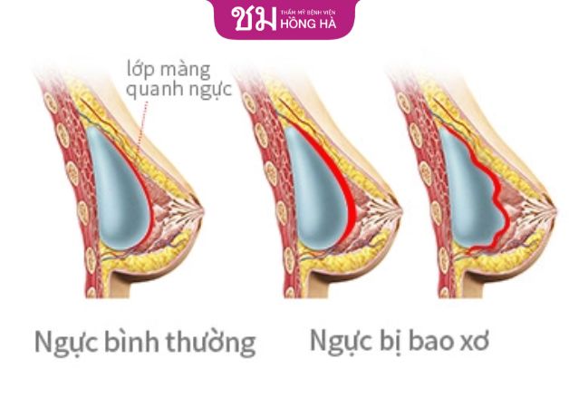 Nguyên nhân dẫn đến bao xơ ngực