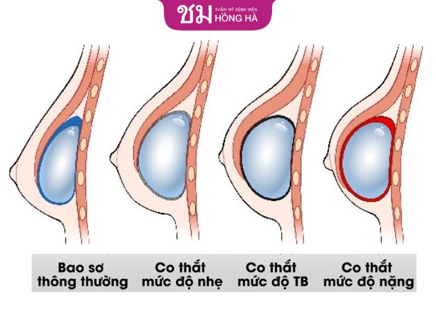Dấu hiệu của bao xơ qua từng giai đoạn