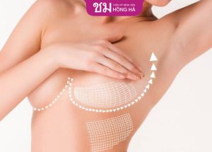 8 Cách cải thiện vòng 1 chảy xệ sau sinh đơn giản