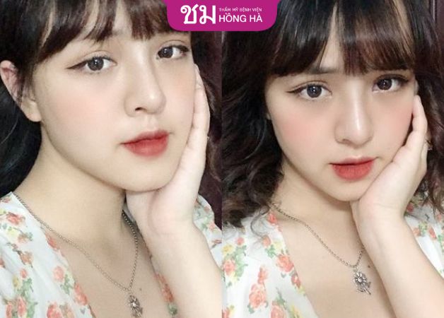 Cắt cánh mũi sau khoảng 1 tháng sẽ lành lặn và đẹp hoàn toàn